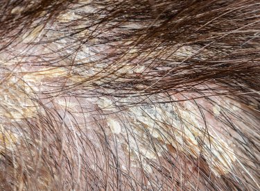 seboroická dermatitida na pokožce hlavy