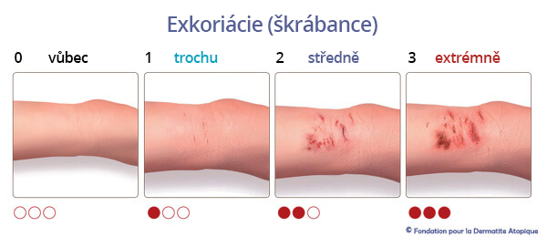 exkoriacie