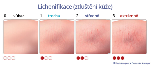 lichenifikace