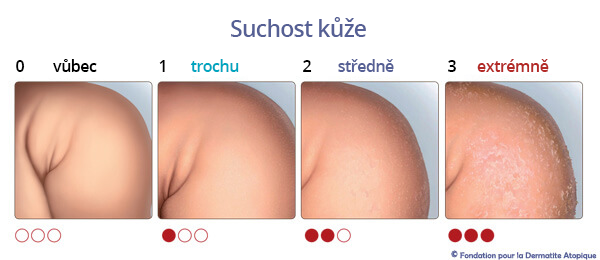 suchost kůže