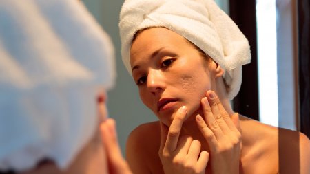 acne scar treatment