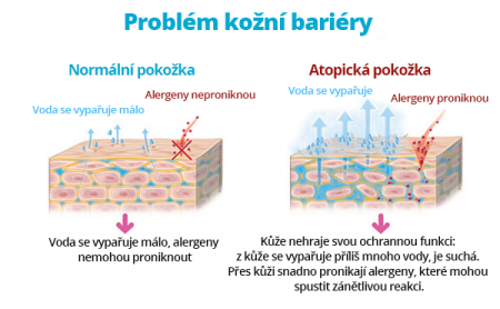 Atopická dermatitida - co byste o ní měli vědět | BIODERMA