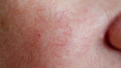 Redness on the face with visible blood vessels with a pink appearance
